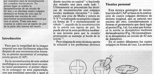 Reconstruccion mamaria postmastectomia
