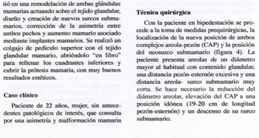 Reducci&oacute;n Mamaria