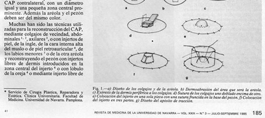 Reconstruccion mamaria postmastectomia