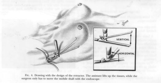 iseño de un nuevo retractor para la cirugia estetica con ayuda de la endoscopia